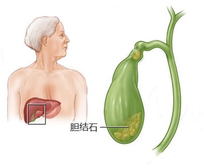 中醫(yī)分析膽結(jié)石的發(fā)作過程