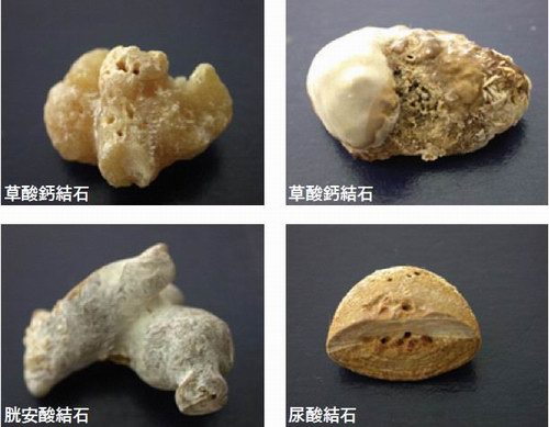 腎結(jié)石不同成分的解說