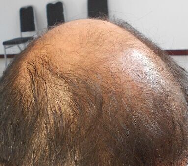 學員鄧首清對嚴重脫發治療的良效