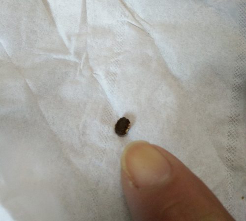 五絕指針療法治療五天排下輸尿管結(jié)石