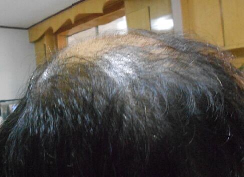 學員鄧首清對嚴重脫發治療的良效