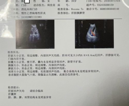 五絕指針療法治療泥沙樣膽囊結石
