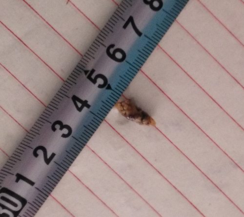 五絕指針療法治療輸尿管末端結(jié)石