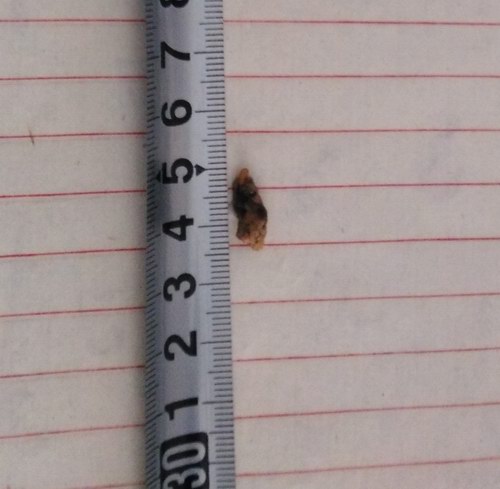 五絕指針療法治療輸尿管末端結(jié)石