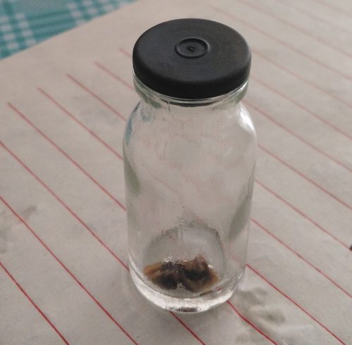 五絕指針療法治療輸尿管末端結(jié)石