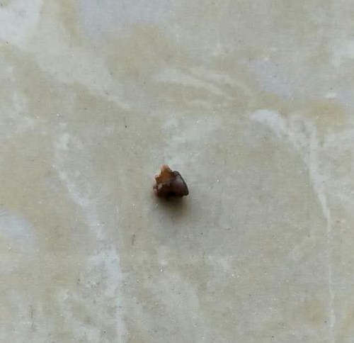 五絕指針治療右側輸尿管末端結石