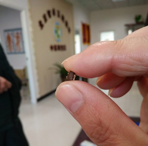 五絕指針療法治療五天排下輸尿管結(jié)石