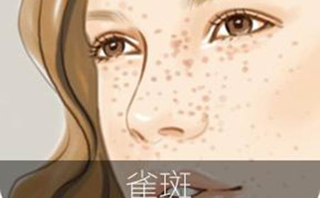 面部雀斑中醫外治法