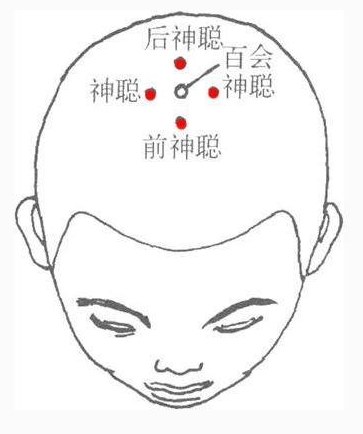 經(jīng)外奇穴—四神聰穴